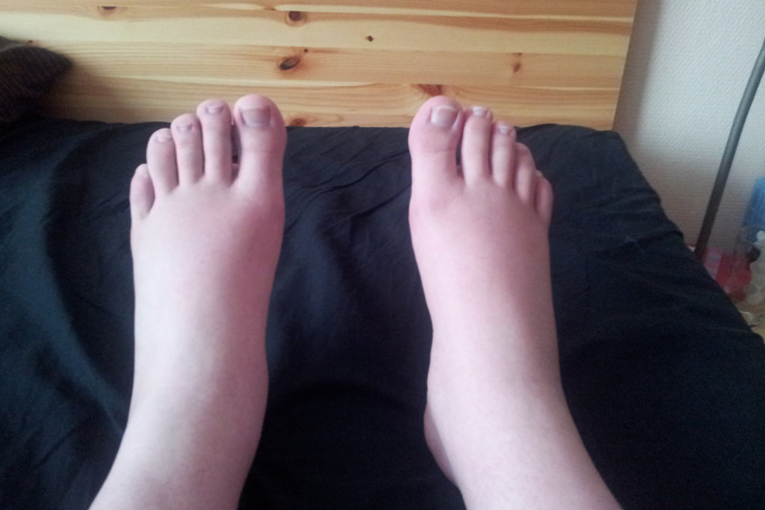 feet-swelling-in-pregnancy-remedies-tips-to-reduce-swelling-in-the